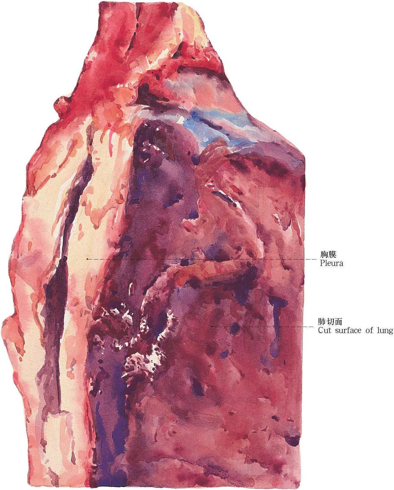29.胸膜玻璃樣變